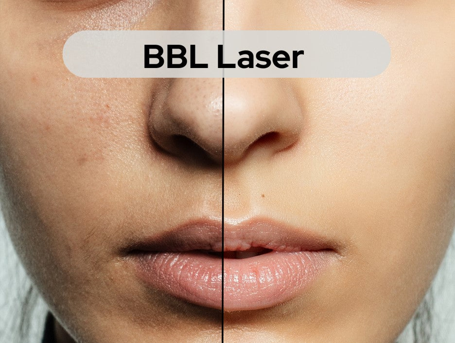 BBL Laser